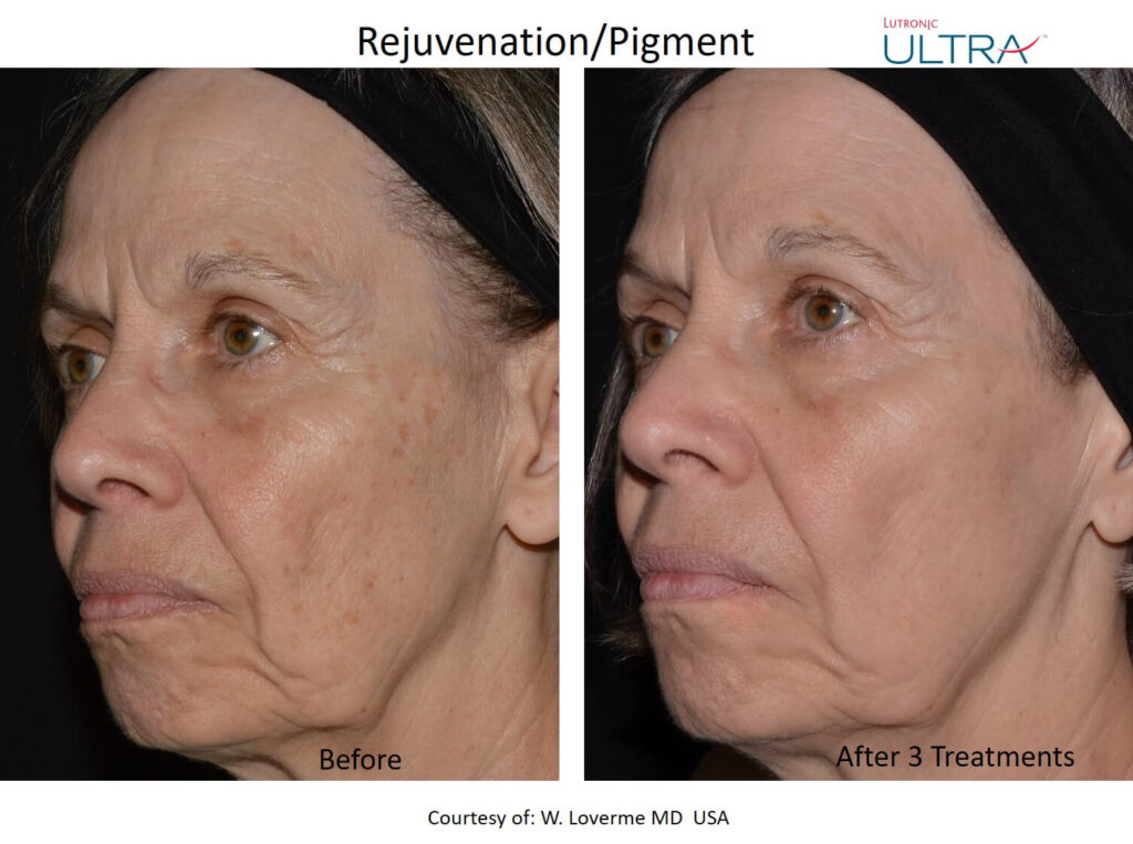 anti aging laser treatment - medical spa in kenner