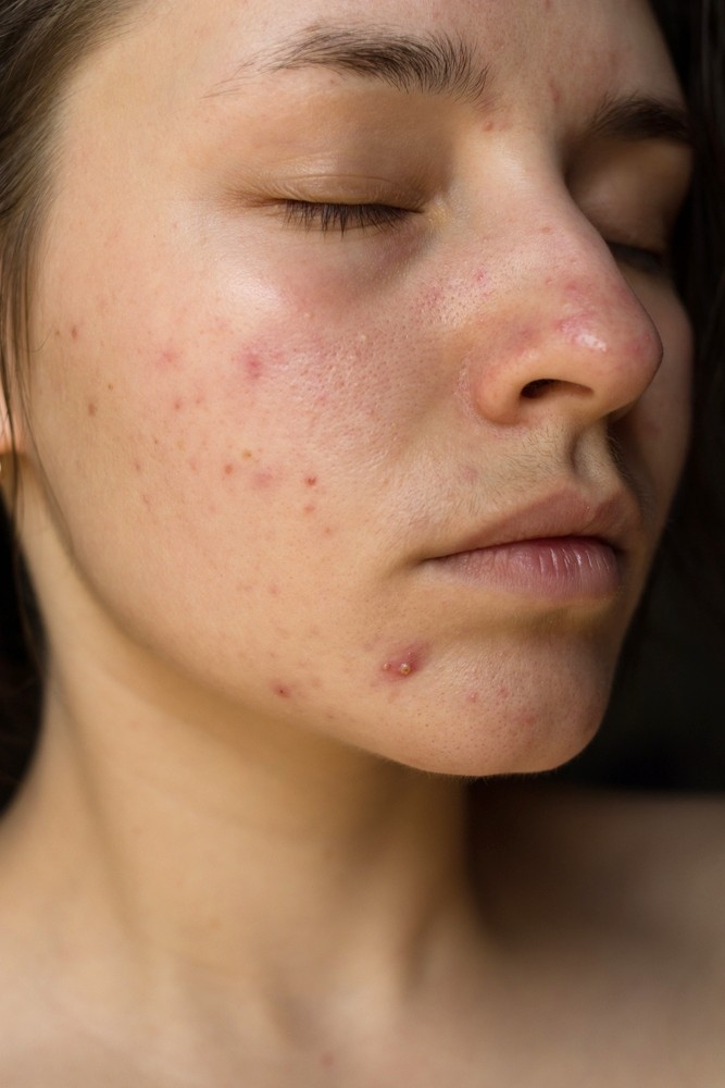 medical spa in kenner - acne and scarring treatment