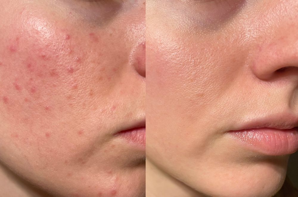 How Can You Stop Acne - med spa acne treatment