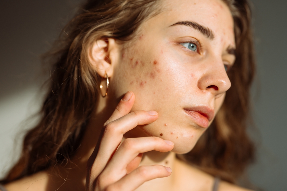 What does your acne try to tell you about your health - acne treatment in kenner - mendoza med spa