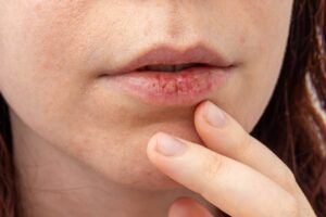 Why Your Skin Feels Extra Dry and Dull After Winter - skin aging treatment in kenner - mendoza med spa