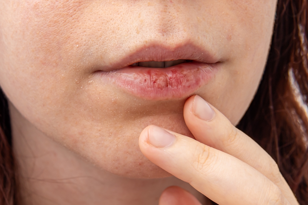 Why Your Skin Feels Extra Dry and Dull After Winter - skin aging treatment in kenner - mendoza med spa