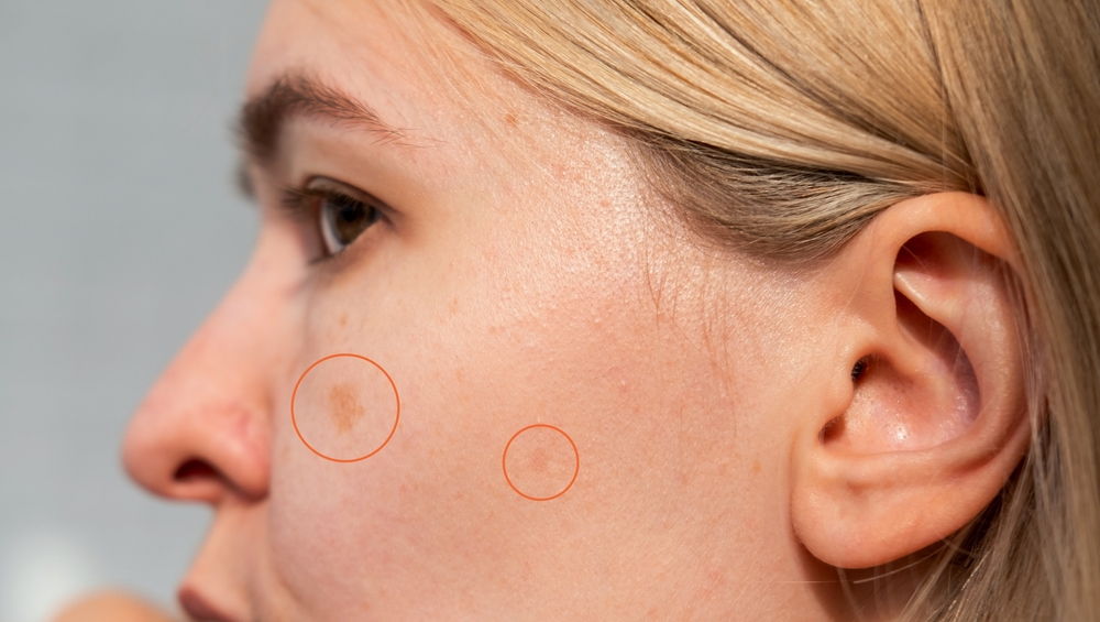 mendoza medical spa in kenner - freckles treatment