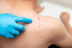 Beat the Heat How to Stop Summer Acne and Breakouts in Their Tracks - medical spa in kenner - mendoza