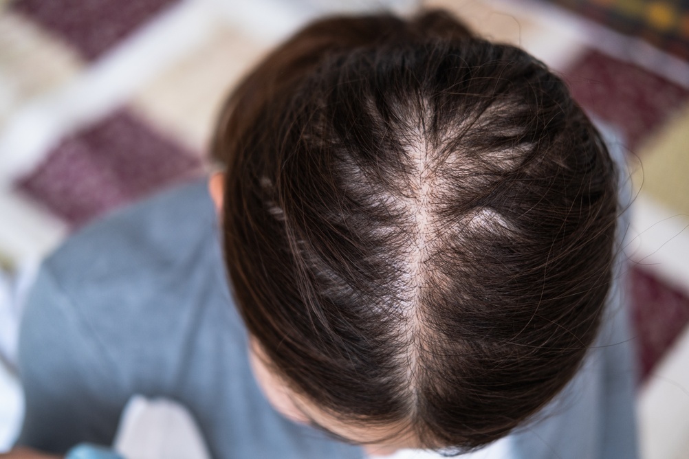 Cuánta caída del cabello es demasiada- med spa en kenner - mendoza