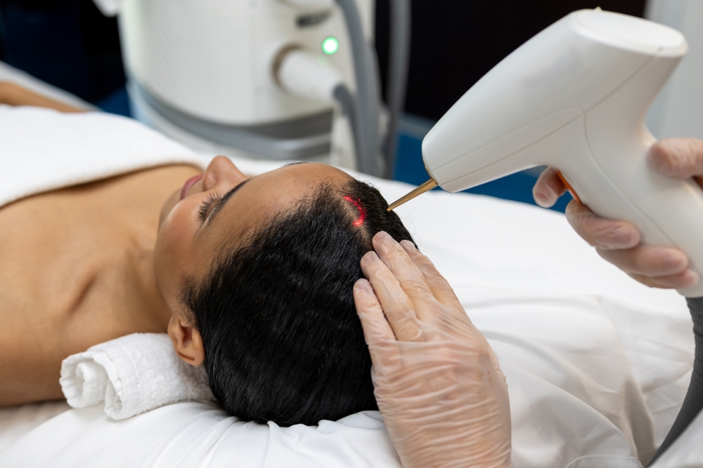 Qué debes saber antes de probar el tratamiento láser para la caída del cabello - mendoza med spa en kenner